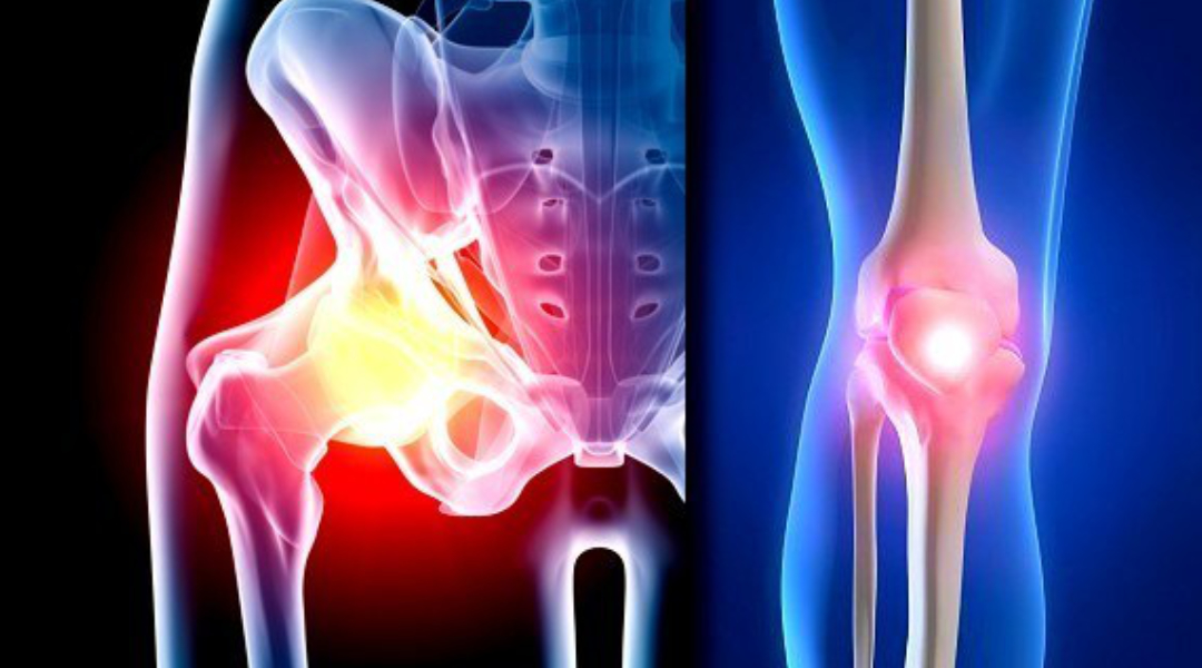 Hip And Knee Osteoarthritis Central Bassendean Physiotherapy 